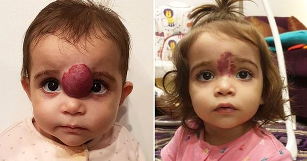 جراحة حساسة تغير حياة طفلة كويتية وُلدت بورم في وجهها